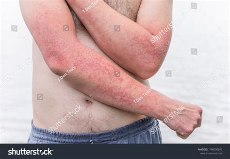 Is Eczema Autoimmune
