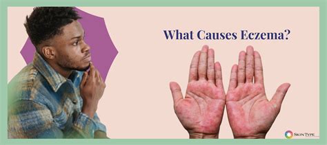 Is Eczema Contagious
