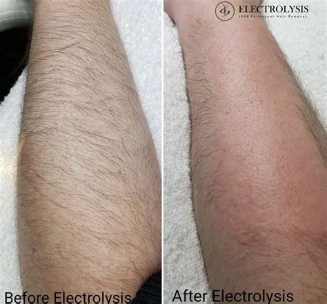 Is Electrolysis Permanent