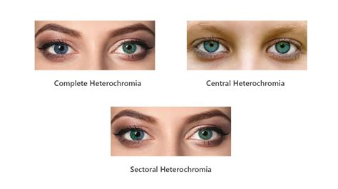 Is Heterochromia Genetic