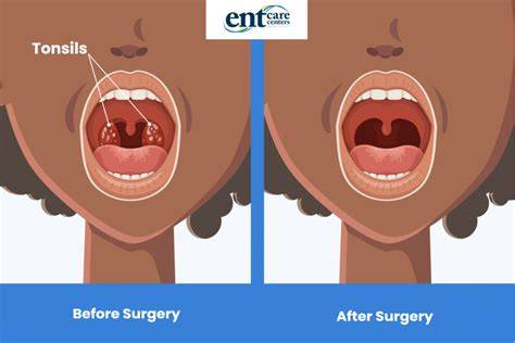 Is It Bad To Get Tonsils Removed