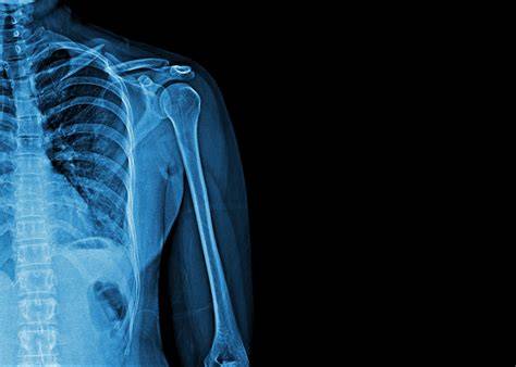 Is It Bad To Get X Rays