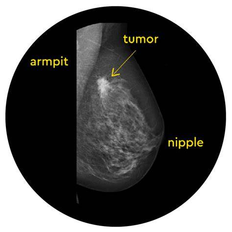 Is It Bad To Xray Breast Milk