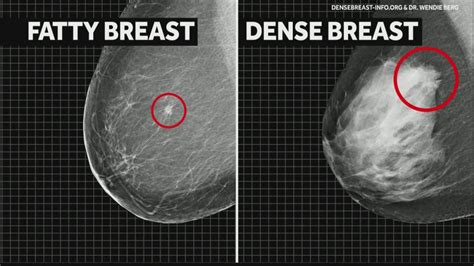 Is It Good To Have Fatty Breasts