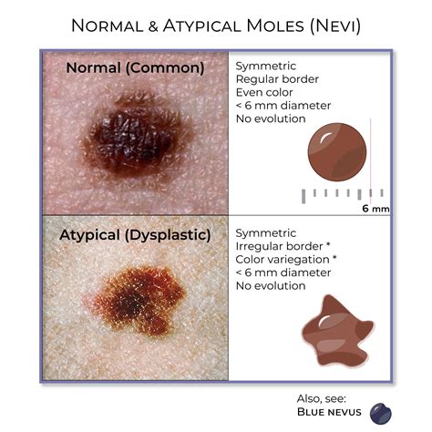 Is It Normal To Develop New Moles