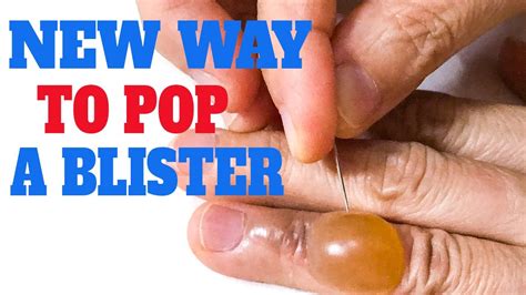 Is It Okay To Pop A Blister