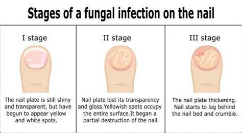 Is Nail Fungus Contagious