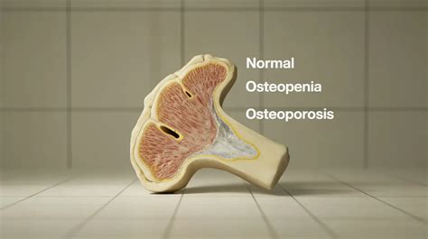Is Osteopenia Reversible