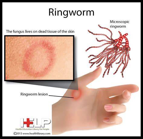 Is Ringworm A Parasite