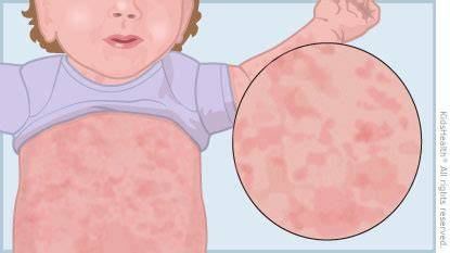 Is Roseola Contagious