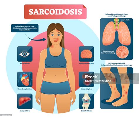 Is Sarcoidosis An Autoimmune Disease