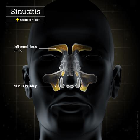Is Sinusitis Contagious