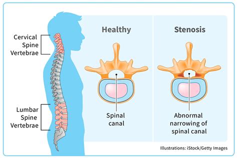 Is Spinal Stenosis Hereditary
