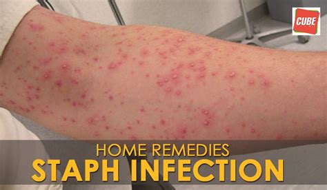 Is Staph Infection Contagious
