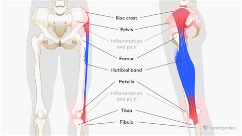 It Band Injury Hip