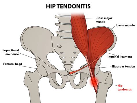It Band Tendonitis Hip Pain
