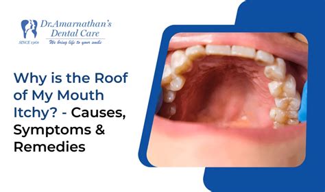 Itch In Roof Of Mouth