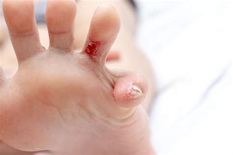 Itching In Between Foot Fingers
