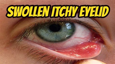 Itchy Eyelids Home Remedy