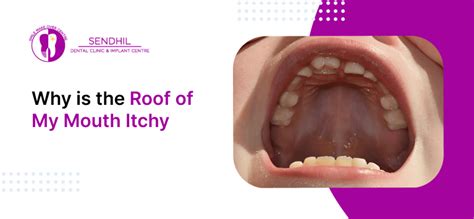 Itchy Roof Of Mouth
