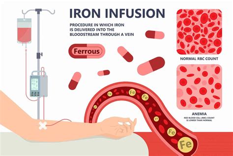 Iv Iron Side Effects