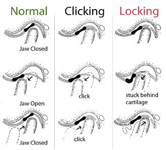 Jaw Locking Up