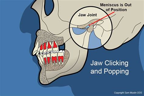 Jaw Popping When Chewing