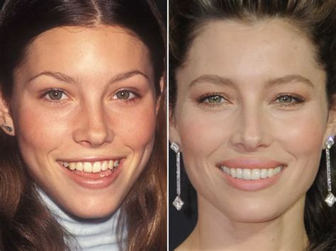 Jessica Biel Face Surgery