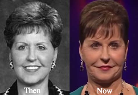 Joyce Meyer Face Surgery