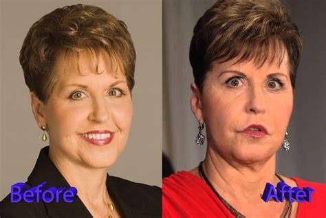 Joyce Meyer Plastic Surgery Face