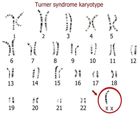 Karyotyping For Turner Syndrome