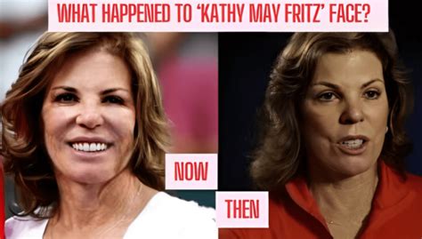 Kathy May Fritz Face Surgery