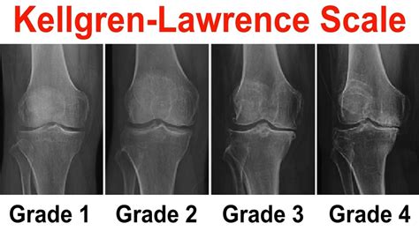 Kellgren Lawrence Scale