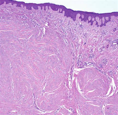 Keloid And Fibrosis