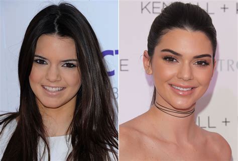 Kendall Jenner Face Before Surgery