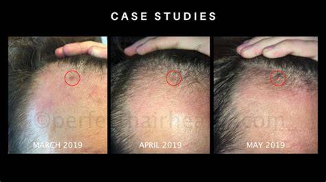 Ketoconazole Hair Loss