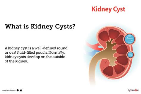 Kidney Cyst Causes