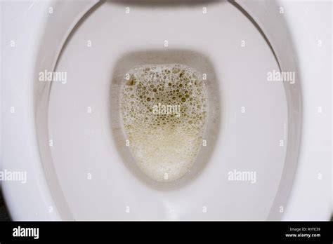 Kidney Stones In The Toilet