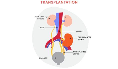 Kidney Transplant Operations