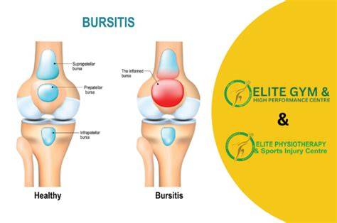 Knee Bursitis Treatment