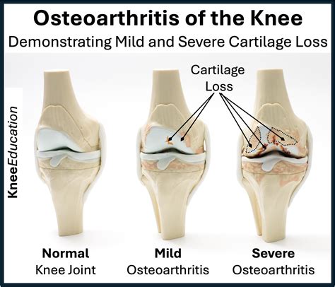 Knee Damage From Arthritis