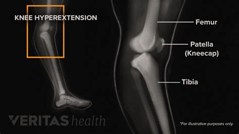 Knee Hyperextension Injury