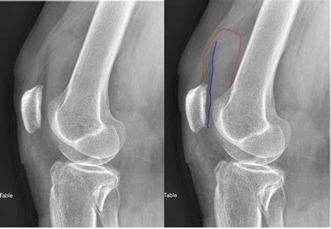 Knee Joint Effusion