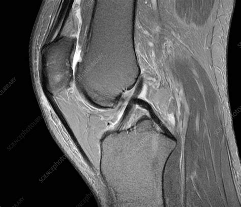 Knee Normal Mri