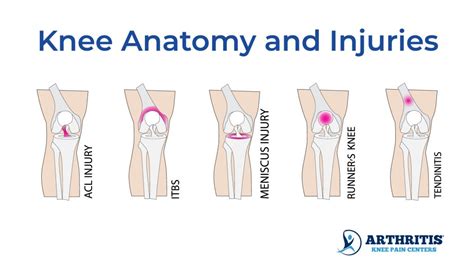 Knee Pain When Straightening Leg
