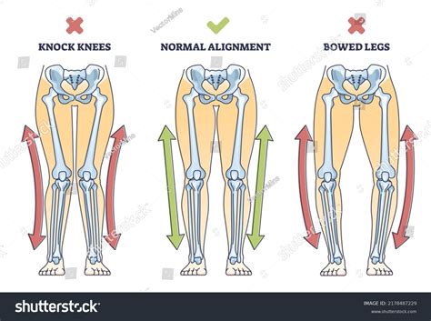 Knees Are Knocking