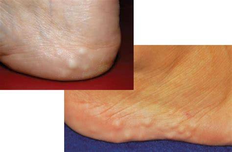 Knot On Back Of Heel