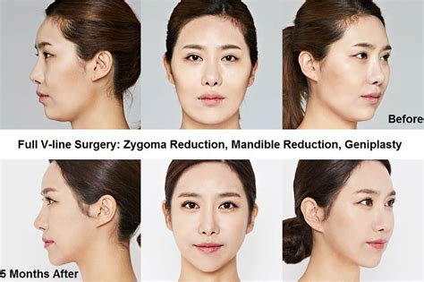 Korean Plastic Surgery Face