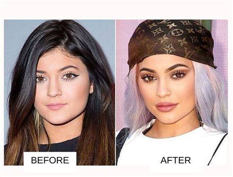 Kylie Before Face Surgery