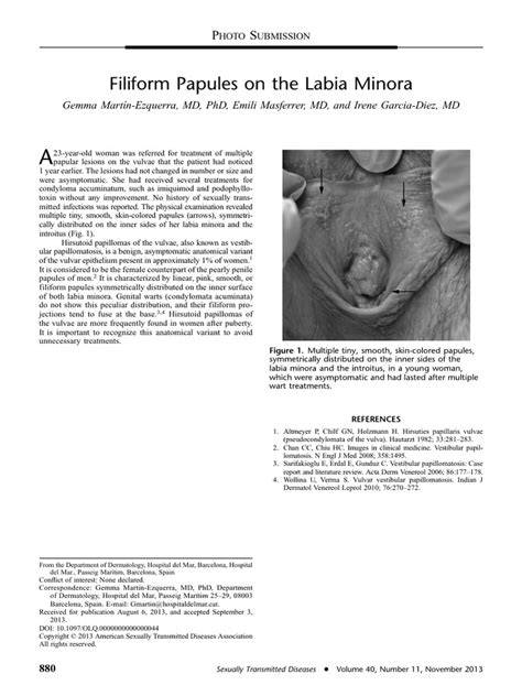 Labia Minora Vanish